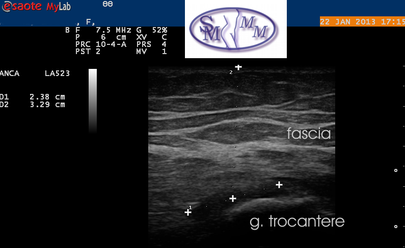 Dr Membrino borsite trocanterica