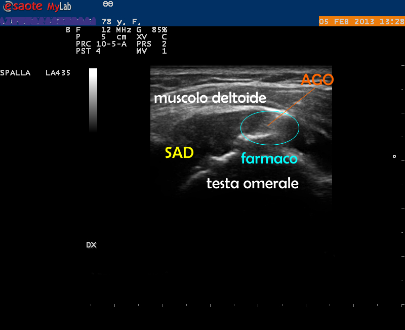 Dr Membrino infiltrazione borsa SAD