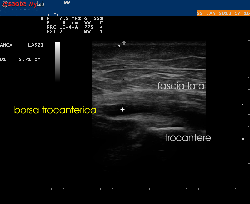 Dr Membrino infiltrazione borsa trocanterica